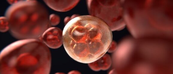 leucemia linfatica cronica aspettative di vita leucemia linfatica cronica aspettative di vita